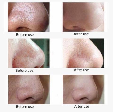 Вакуумный аппарат для чистки лица DermaSuction